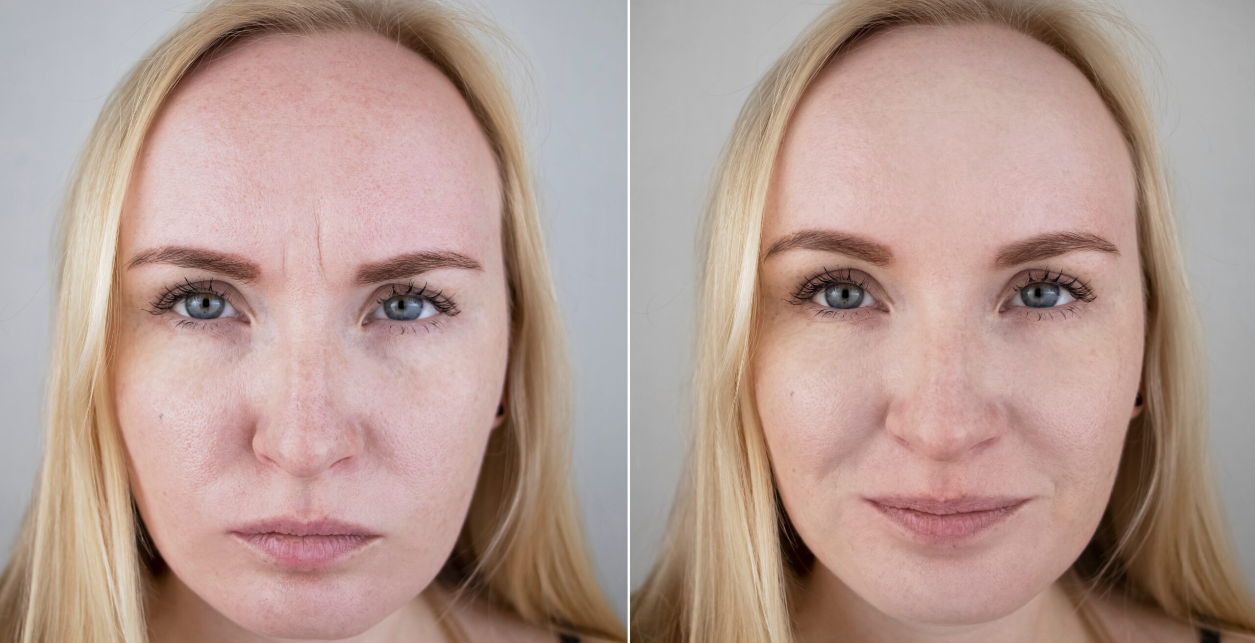 Photos before and after mesotherapy, biorevitalization, botulinum toxin injections. skin fold between eyebrows, forehead wrinkles. at the appointment with a plastic surgeon or cosmetologist