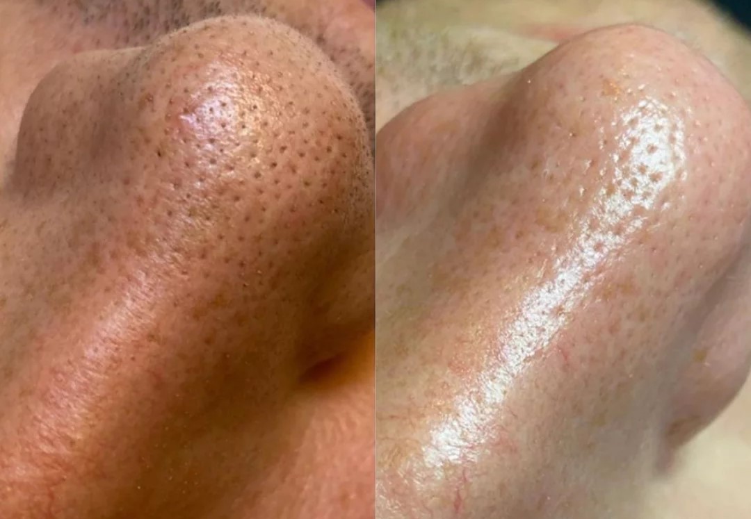 Hydrafacial5